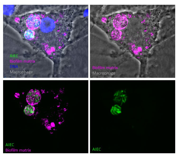 Figure 3: Human macrophages infected by AIEC bacteria (red). The bacteria form intracellular communities inside toxic phagolysosomes labeled by Lamp1 (green)