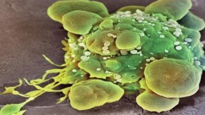 Cellule cancéreuse humaine au microscope, colorisée en vert et jaune avec des protubérances