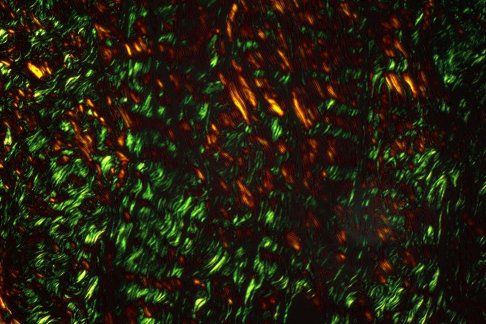 False color image showing collagen fibers in green and orange in breast tumor tissue, revealing the organization of fibrillar structures.