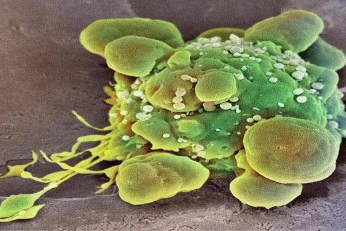 Cellule cancéreuse humaine au microscope, colorisée en vert et jaune avec des protubérances